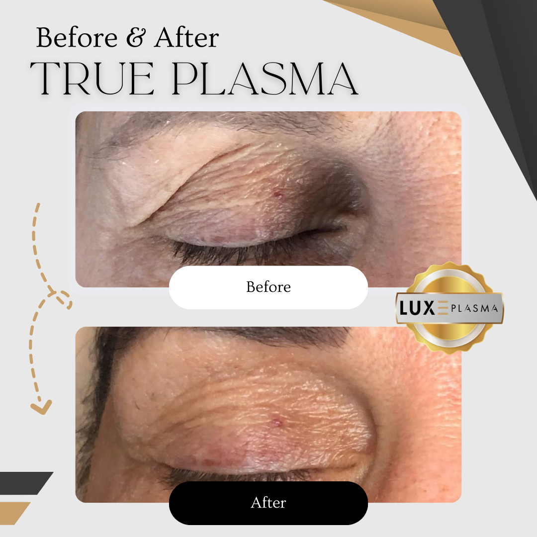 PLAXEL “LUXE Edition” Plasma Pen