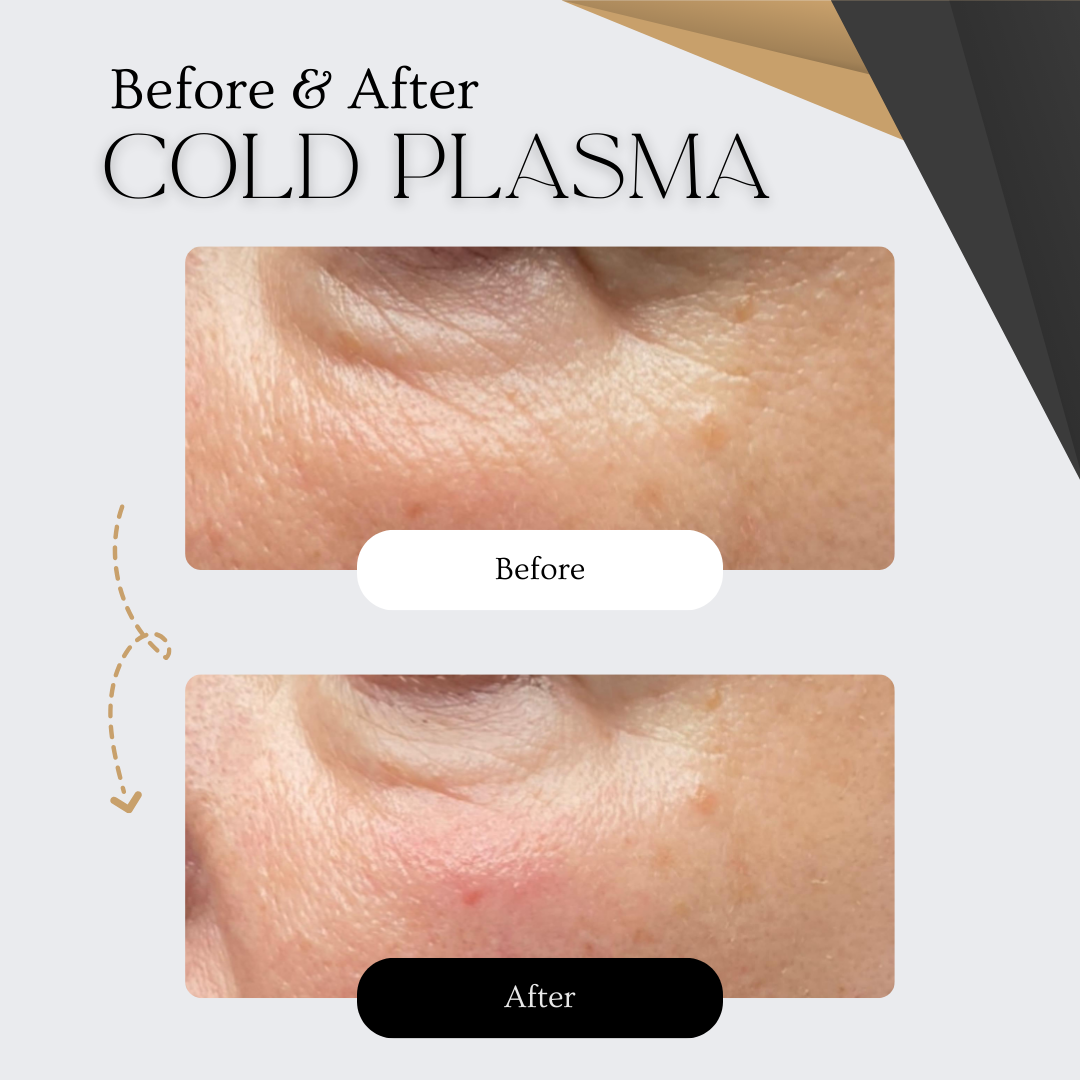 PLAXEL “LUXE Edition” Plasma Pen