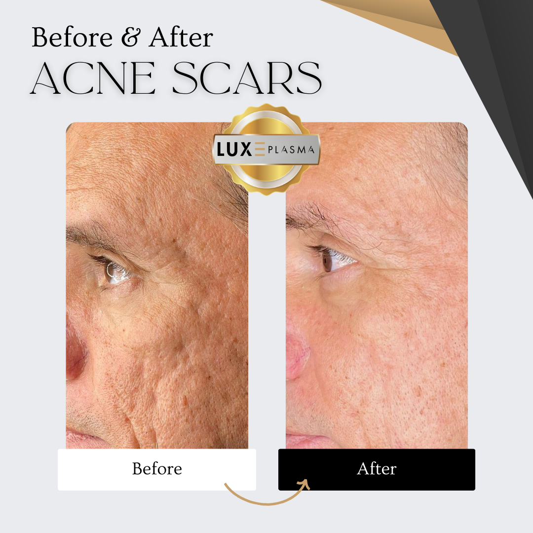 PLAXEL “LUXE Edition” Plasma Pen