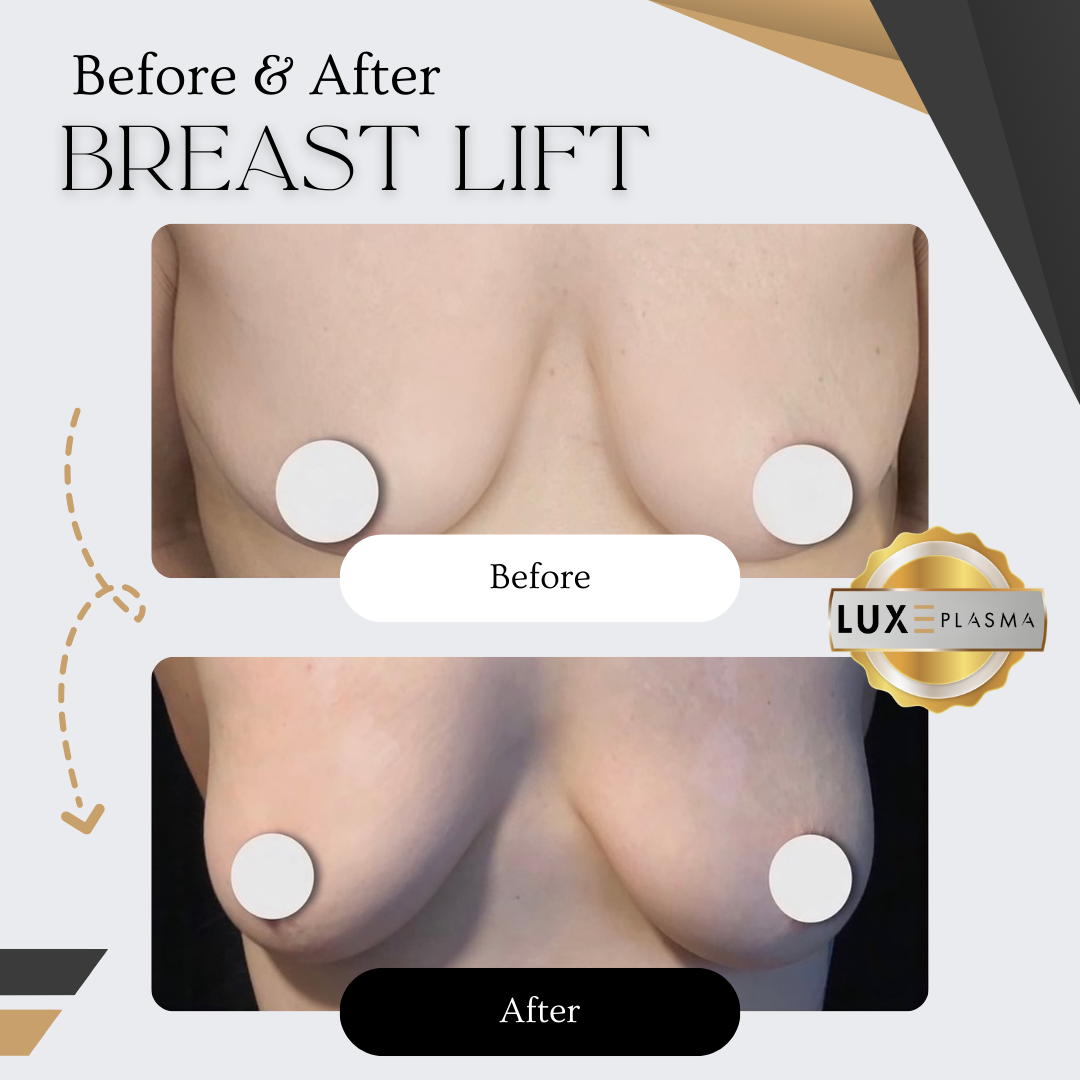 PLAXEL “LUXE Edition” Plasma Pen