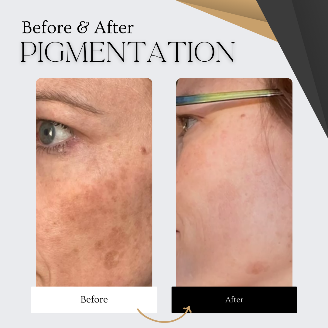 PLAXEL “LUXE Edition” Plasma Pen